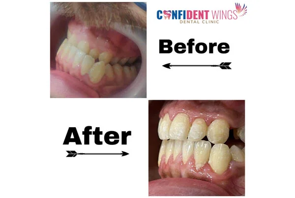 Orthodontic Case