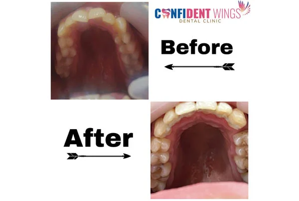 Orthodontic Case
