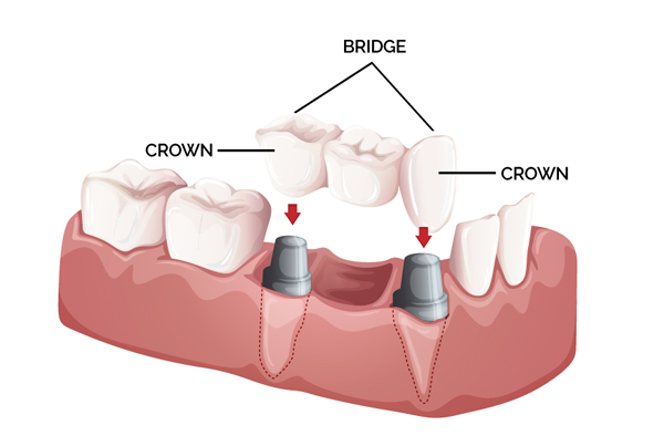 Crown