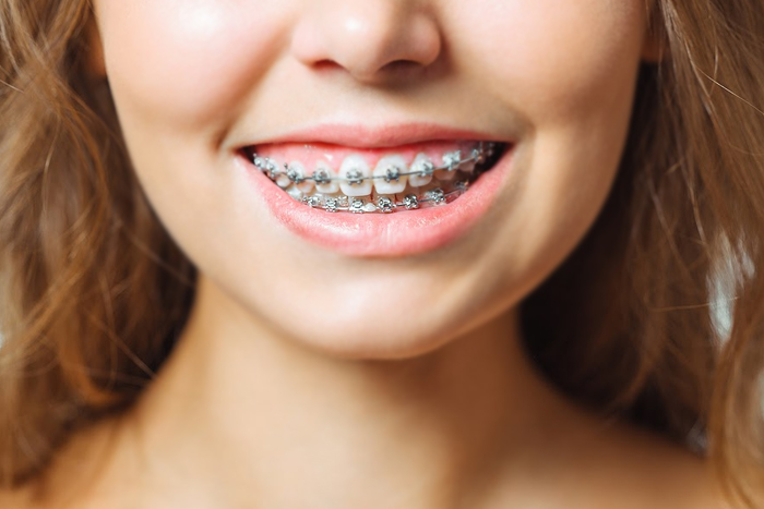 Metal Braces