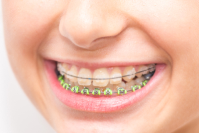 Ceramic Braces