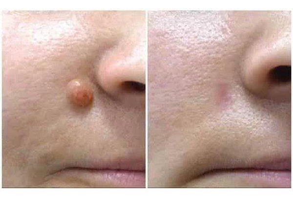 Skin Tag/Mole Removal